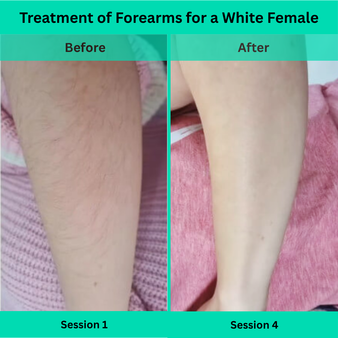Before and After picture of Laser Hair Removal Treatment of Forearms for a White Female